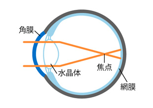 A）装用前（近視の状態）