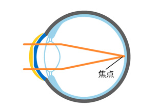 B） 装用中