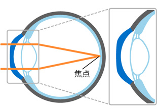 C） 装用後（裸眼時）